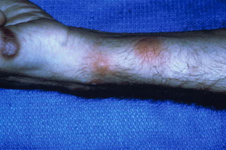 image of Kaposi sarcoma: with staphylococcal abscesses