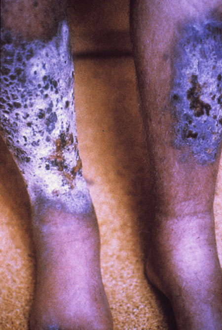 image of Kaposi sarcoma: on bilateral shins