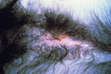 image of Condyloma: perianal