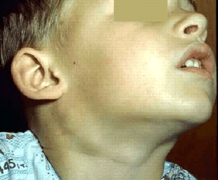 image of Persistent generalized lymphadenopathy