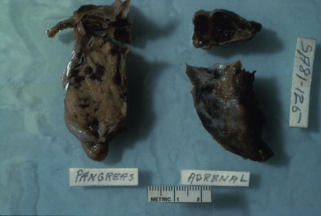 image of Kaposi sarcoma: pancreas and adrenal glands at autopsy