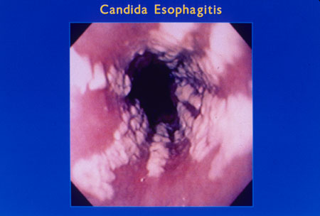 image of Candida esophagitis