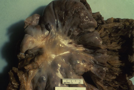 image of Kaposi sarcoma: small bowel at autopsy