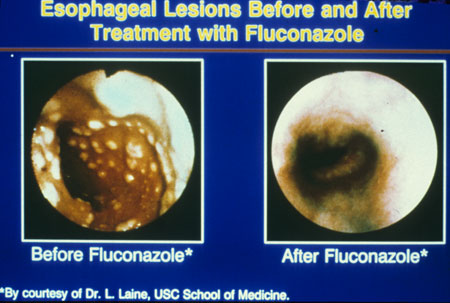 image of Candidal esophagitis: lesions before and after treatment with fluconazole