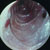thumbnail image of Kaposi sarcoma: gastrointestinal lesion seen on endoscopy