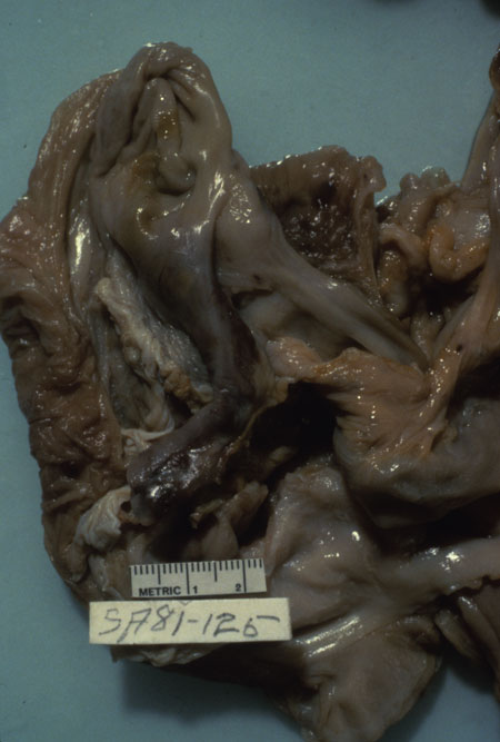 image of Kaposi sarcoma: appendix at autopsy
