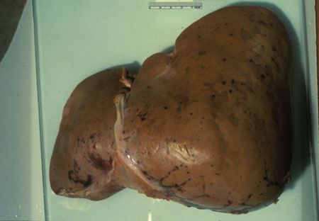 image of Kaposi sarcoma: liver at autopsy