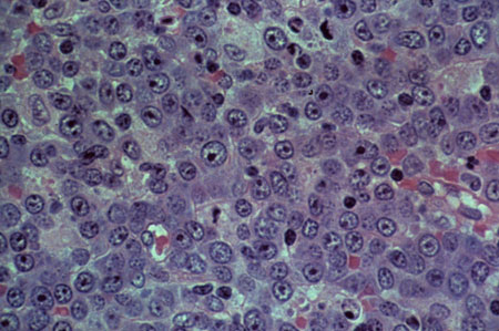 image of Non-Hodgkin lymphoma: immunoblastic type