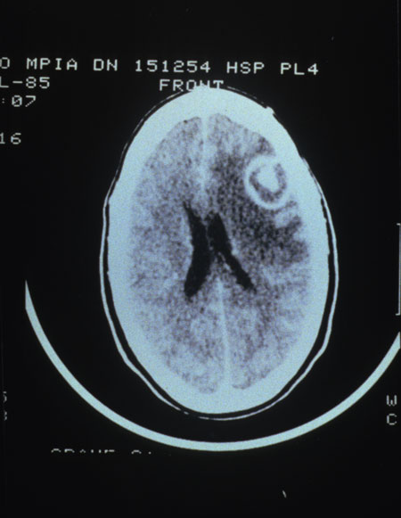 image of  Toxoplasma gondii
                    : CT scan showing cerebral abscess
                