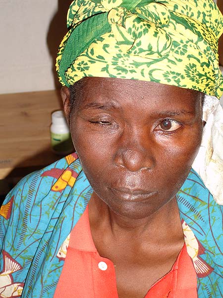 image of Facial palsy: left side of an HIV-infected woman