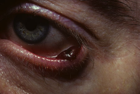 image of Kaposi sarcoma: eyelid