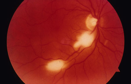 image of  Toxoplasma gondii
                    : retinal lesions (full thickness)
                