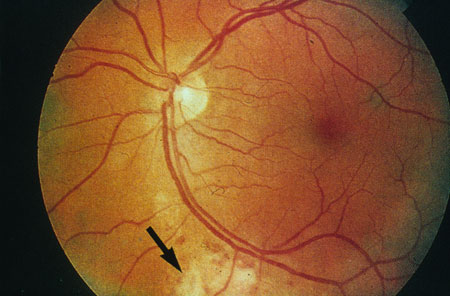 image of Cytomegalovirus retinitis: zone of retinal necrosis