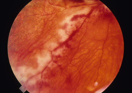 image of Cytomegalovirus retinitis