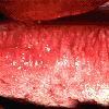 thumbnail image of Oral hairy leukoplakia: appearing as corrugations on the lateral margin of the tongue