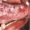 thumbnail image of Oral hairy leukoplakia: extensive