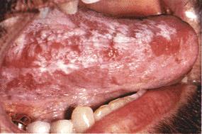 image of Oral hairy leukoplakia: extensive