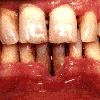 thumbnail image of Necrotizing periodontal disease