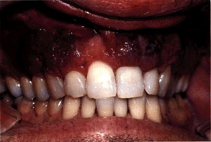 image of Kaposi sarcoma: occurring in the gingiva