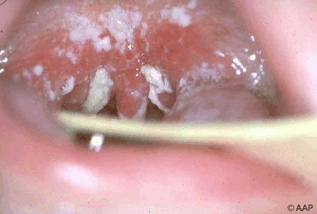 image of Candidiasis: oral