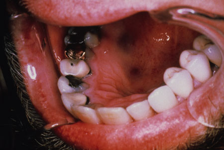 image of Kaposi sarcoma: hyperpigmented lesions of floor of mouth