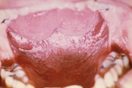 image of Candidiasis: pseudomembranous