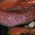 thumbnail image of Oral hairy leukoplakia
