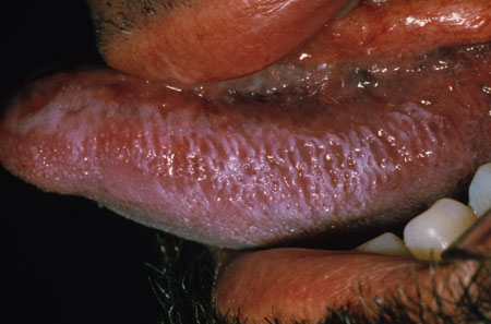 image of Oral hairy leukoplakia