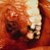 thumbnail image of Kaposi sarcoma: oropharynx