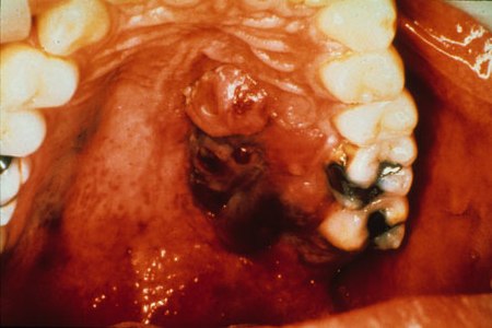 image of Kaposi sarcoma: oropharynx