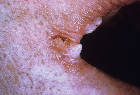 image of Angular cheilitis