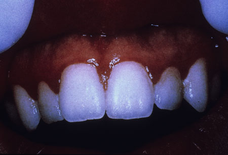 image of Gingival erythema: linear