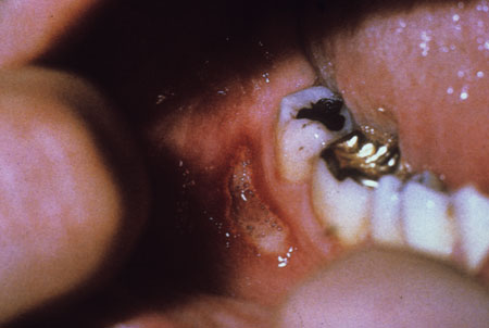 image of Aphthous ulcers