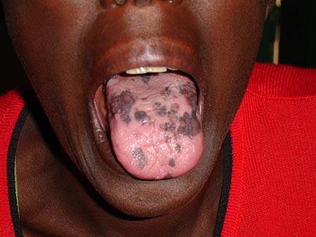 image of Hyperpigmentation: of the tongue (spontaneous) in an HIV-infected woman receiving antiretrovirals