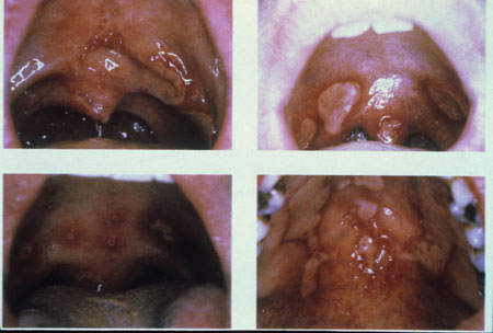 image of Aphthous ulcers
