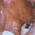 thumbnail image of Thrush: erythematous