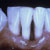thumbnail image of Periodontitis: ulcerative