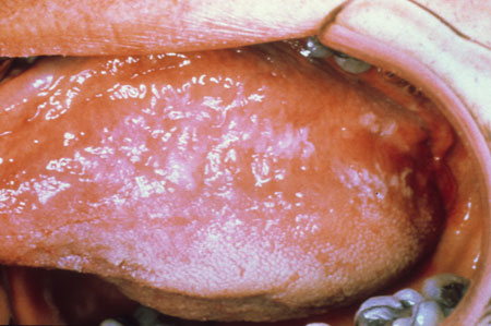 image of Oral hairy leukoplakia