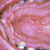 thumbnail image of Warts: oral