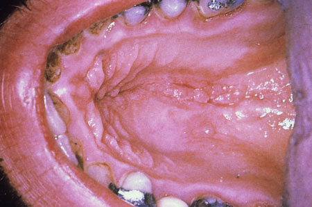 image of Warts: oral