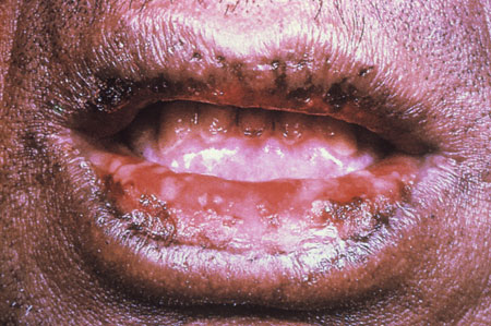 image of Stevens-Johnson syndrome