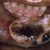 thumbnail image of Actinomycosis