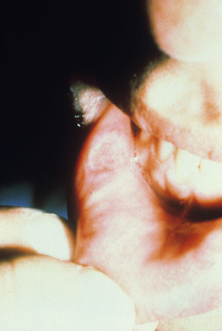 image of Ulcer: idiopathic