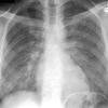 thumbnail image of  Pneumocystis jiroveci
                    (formerly
                    carinii
                    ) pneumonia: chest X ray with bilateral, diffuse granular opacities
                
