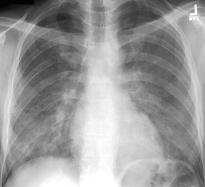 image of  Pneumocystis jiroveci
                    (formerly
                    carinii
                    ) pneumonia: chest X ray with bilateral, diffuse granular opacities
                