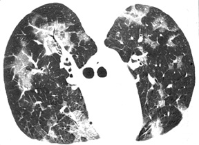 image of  Pneumocystis jiroveci
                    : HRCT scan in a patient with a normal chest X ray
                