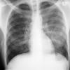 thumbnail image of  Pneumocystis jiroveci
                    : chest X ray with unilateral granular opacities
                