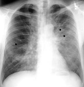 image of  Pneumocystis jiroveci
                    : chest X ray with bilateral granular opacities and cysts
                