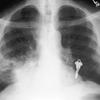 thumbnail image of Tuberculosis: chest X ray with a focal opacity