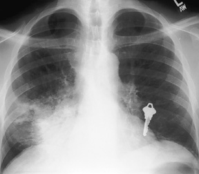 image of Tuberculosis: chest X ray with a focal opacity